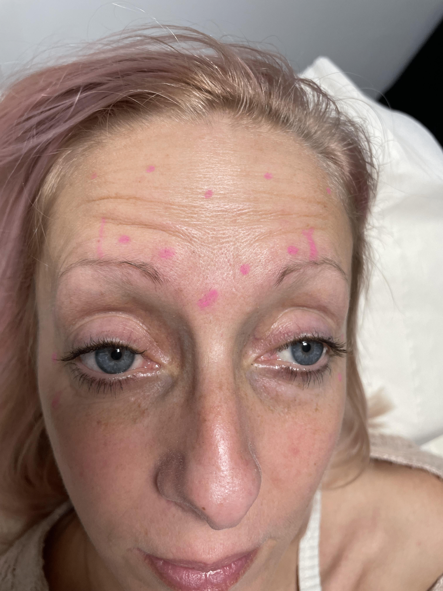 Before — Anti-wrinkle treatment