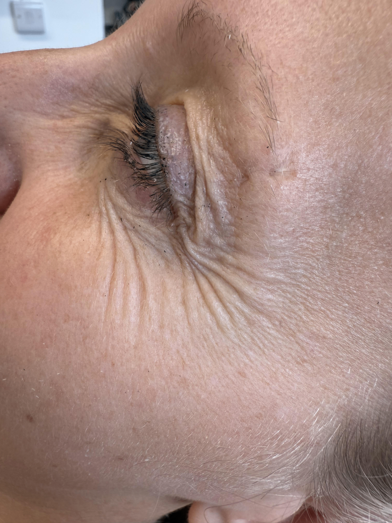 Before — Crow's feet — anti-wrinkle injections