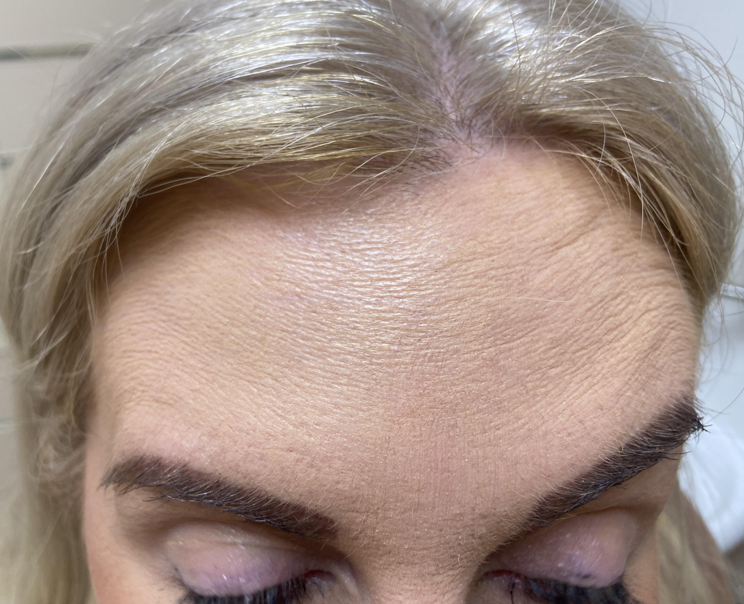 After — Forehead lines — anti-wrinkle injections
