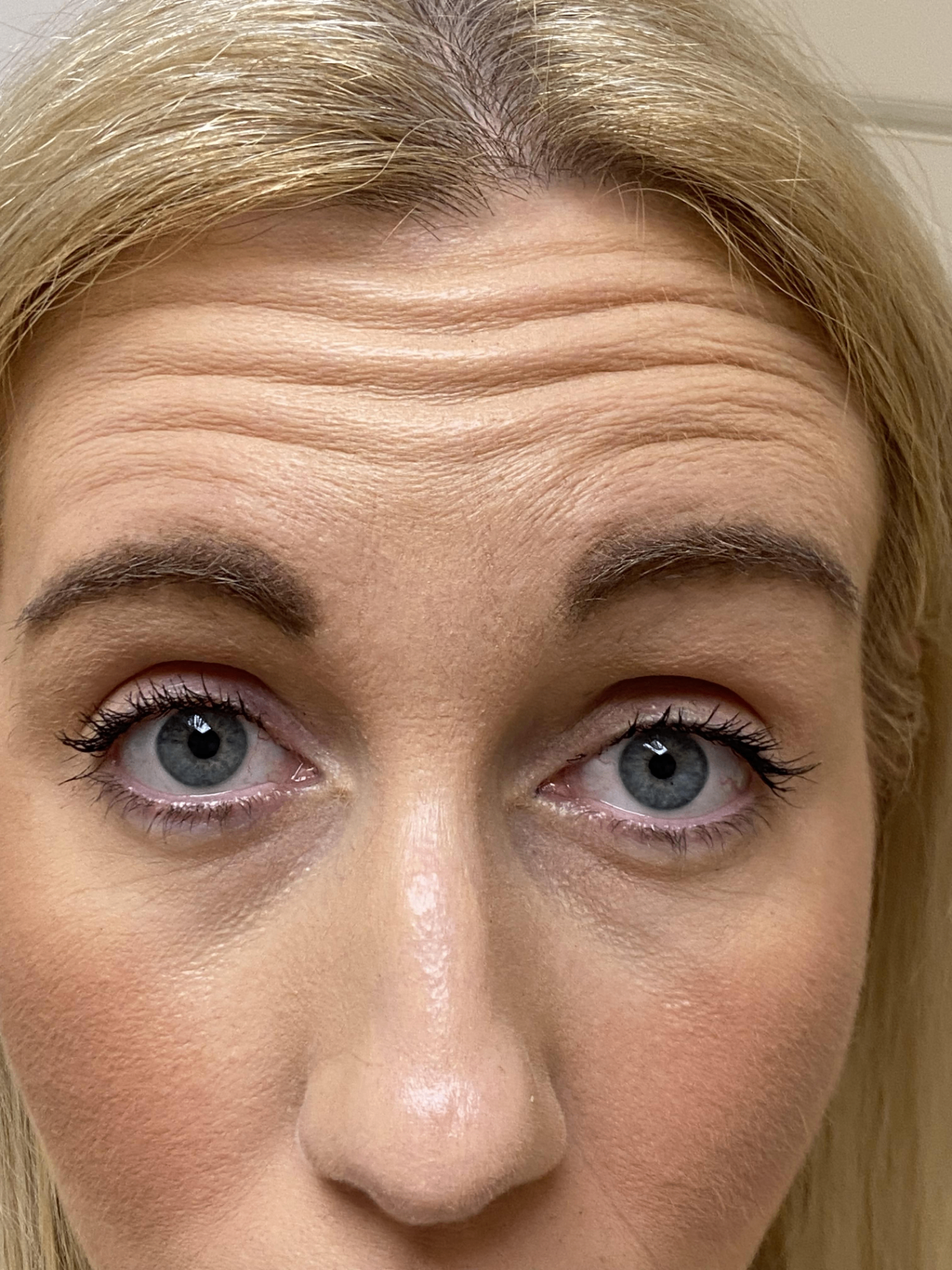 Before — Forehead lines — anti-wrinkle injections