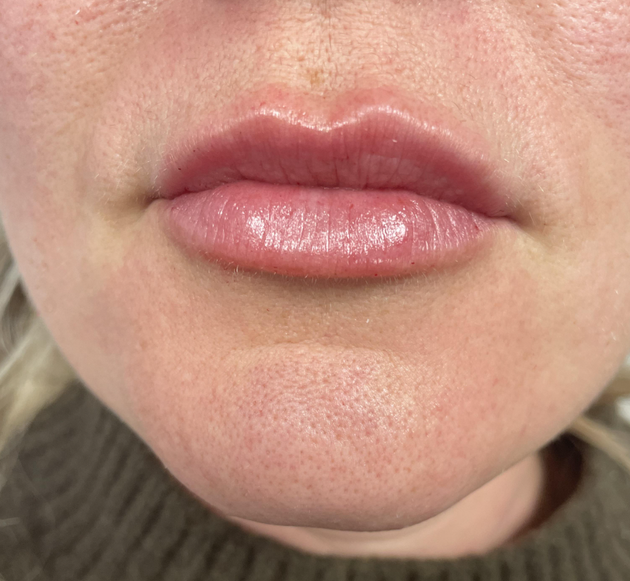 After — Lip enhancement — dermal fillers