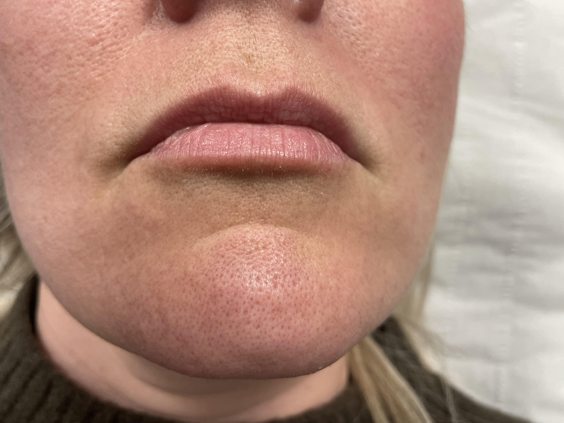 Before — Lip enhancement — dermal fillers