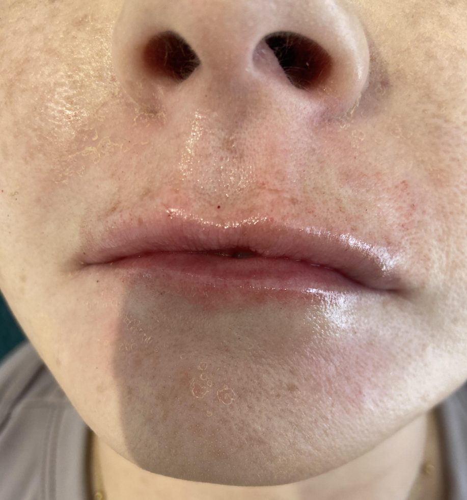 After — Lip enhancement — dermal fillers