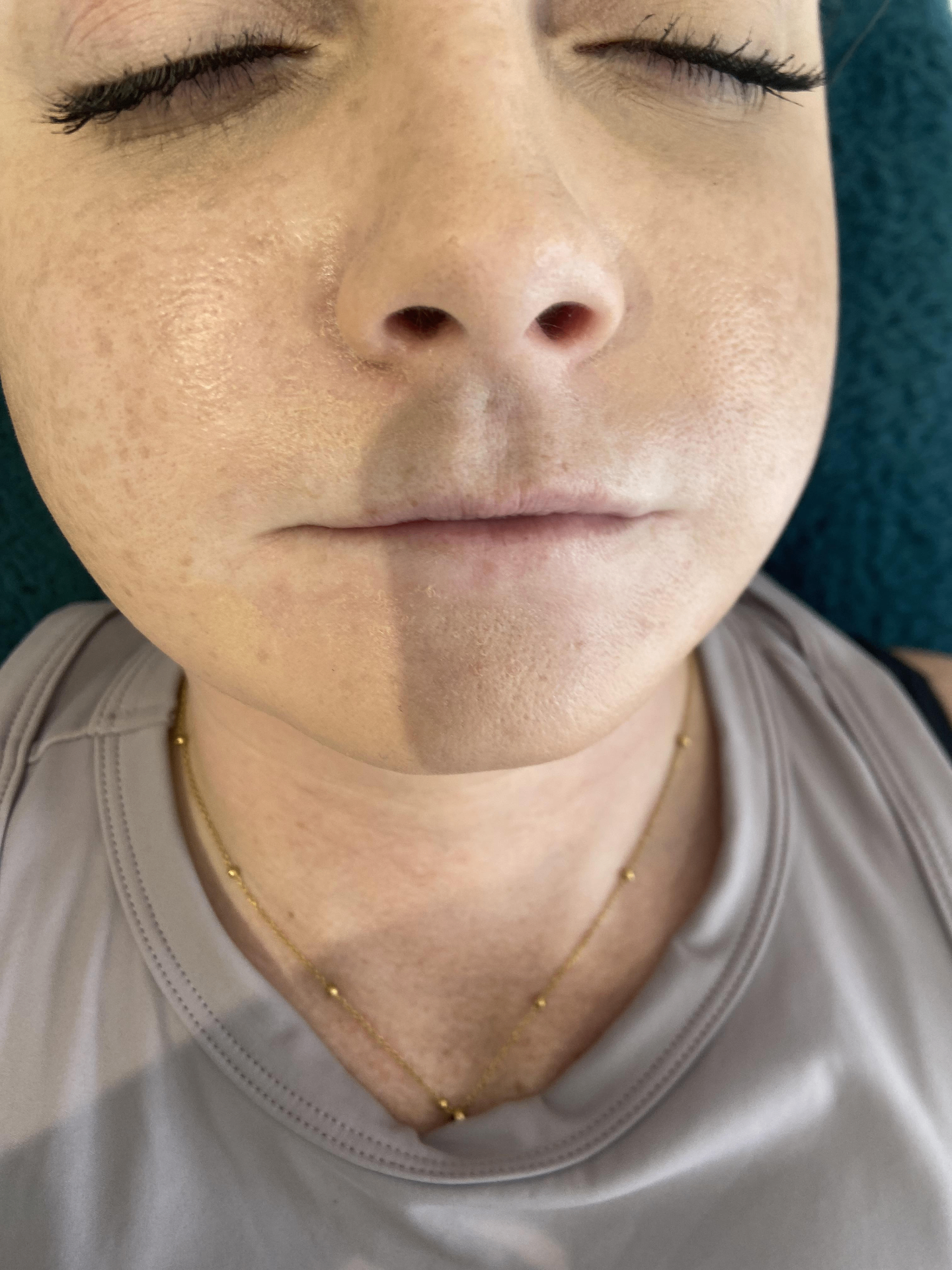 Before — Lip enhancement — dermal fillers