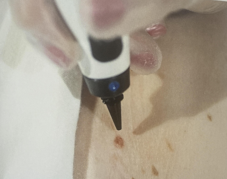 Skin Lesion Removal (Cryotherapy)